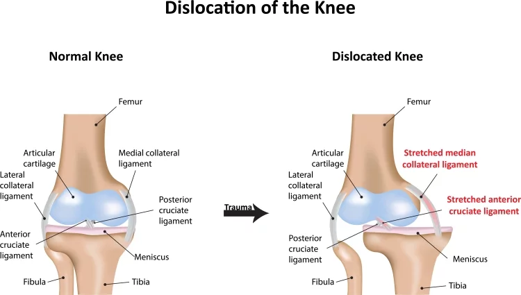Anterior Cruciate Ligament Injuries 