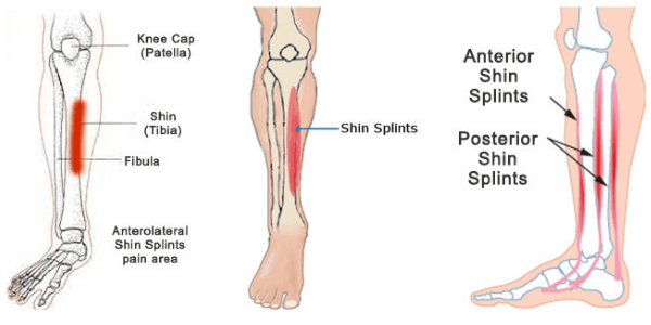 Stress Fracture From Shin Splints